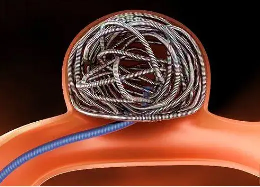  MA市場準入 | 神經(jīng)介入②顱內(nèi)彈簧圈系統(tǒng)-臨床評價路徑